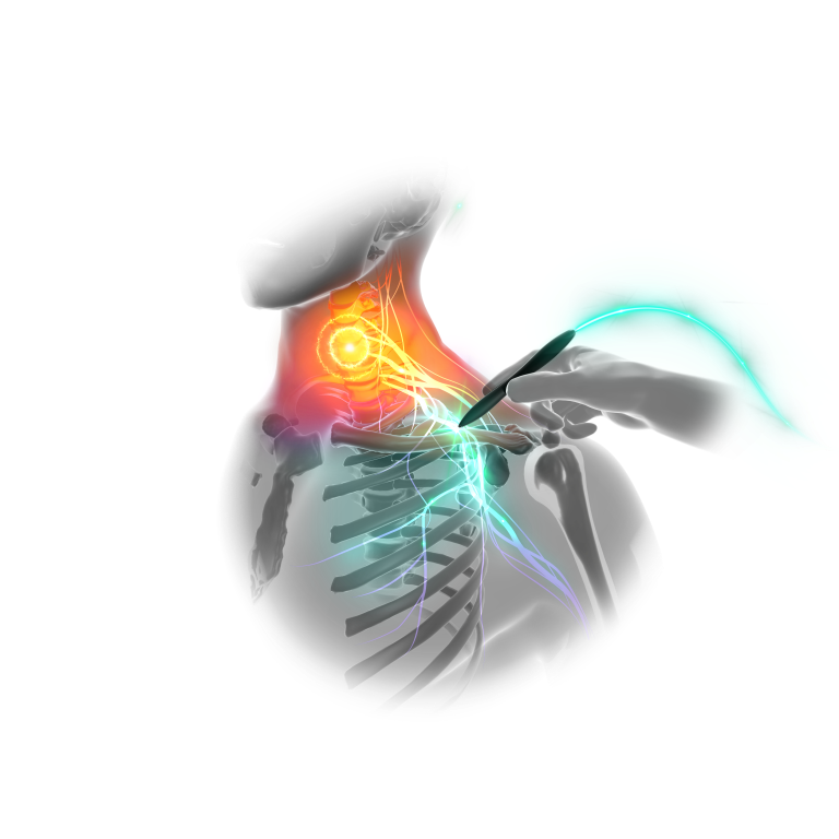 brachial-plexus-pain