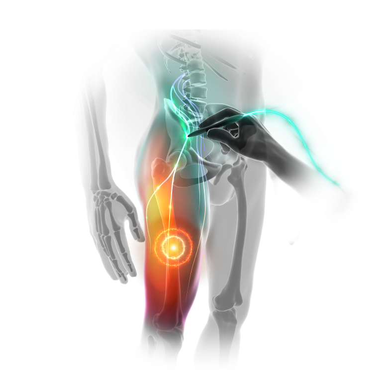 femoral-nerve-pain
