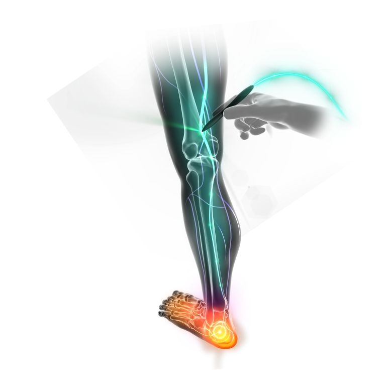 sciatic-nerve-pain